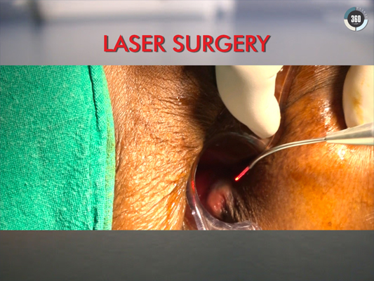 Laser Piles Treatment in Delhi