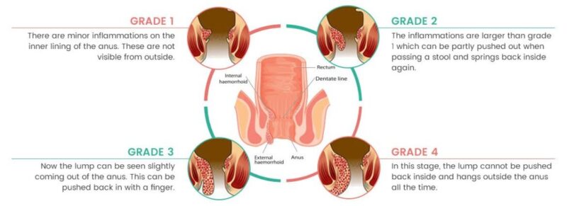 treatment for piles