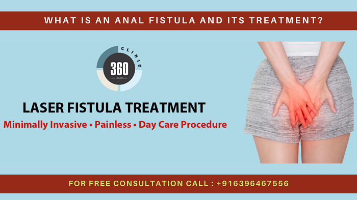 laser treatment for fistula in Delhi
