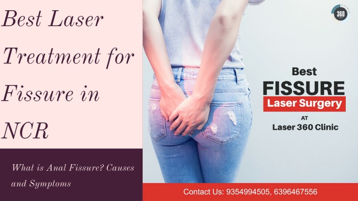 Fissure Surgery by Laser