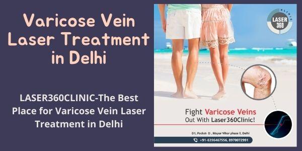 Varicose Vein Laser Treatment