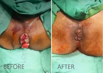 Fissure Surgery in Delhi