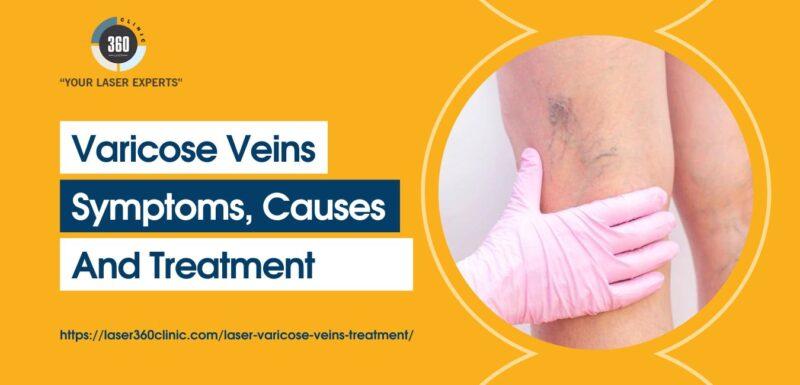 Varicose Veins Symptoms Causes And Treatment