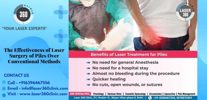 Laser piles treatment cost