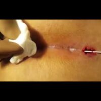 Laser Pilonidal Sinus treatment || Laser Pilonidoplasty || Painless , Bloodless , Scarless.
