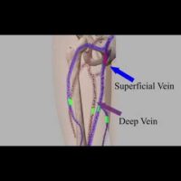 Laser varicose vein treatment || Endovenous Laser treatment || Painless, Bloodless , Scarless